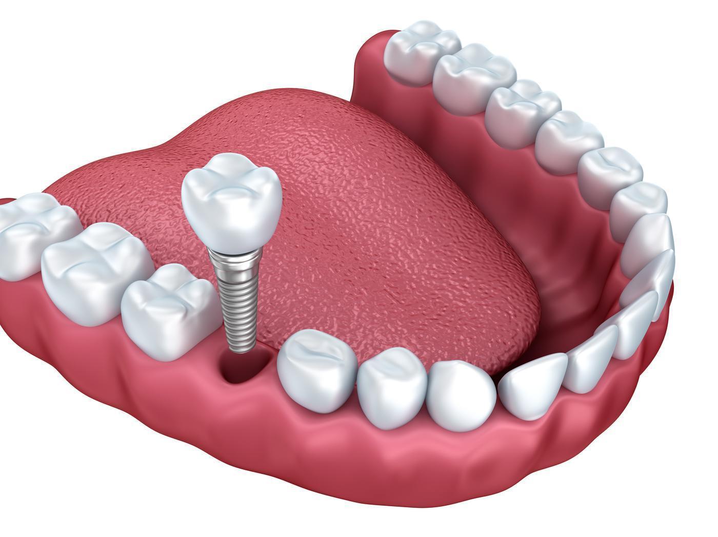 North Mankato Implant Dentistry